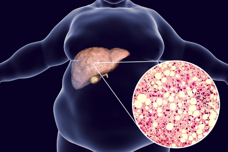 Лечение гепатоза печени: чем и как лечить жировой гепатоз